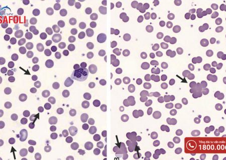 Tìm hiểu về bệnh thiếu máu tan máu: Nguyên nhân và cách phòng ngừa