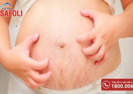 Chăm sóc rạn da khi mang thai cho mẹ bầu