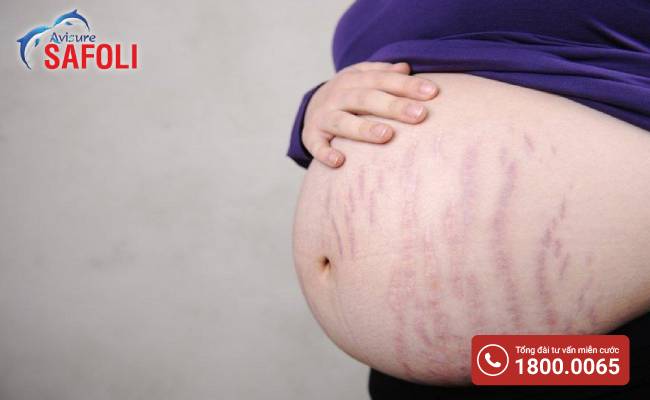 90% phụ nữ gặp phải hiện tượng rạn da khi bước vào giai đoạn giữa của thai kỳ