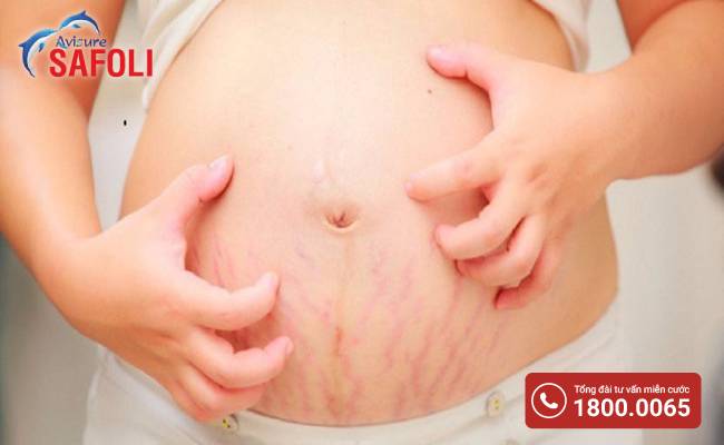 Rạn da khi mang thai không gây đau nhưng có thể làm mẹ sẩn ngứa