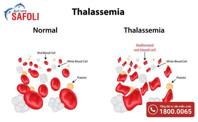 Thiếu máu bẩm sinh hay còn gọi là Thalassemia