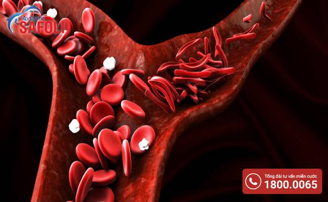 Thiếu máu hồng cầu hình liềm là một bệnh lý di truyền gen lặn