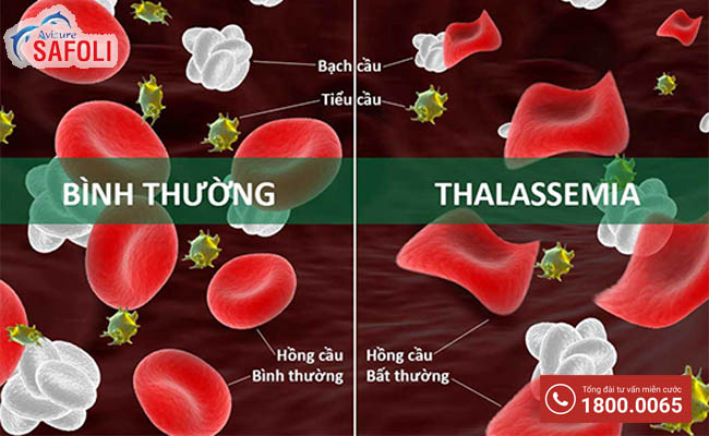 Thiếu máu do gen bệnh Thalassemia