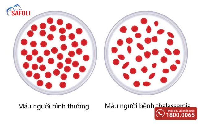 Thiếu máu huyết tán thalassemia là bệnh thiếu máu tan máu do người bệnh mang nguồn gen di truyền gây bệnh