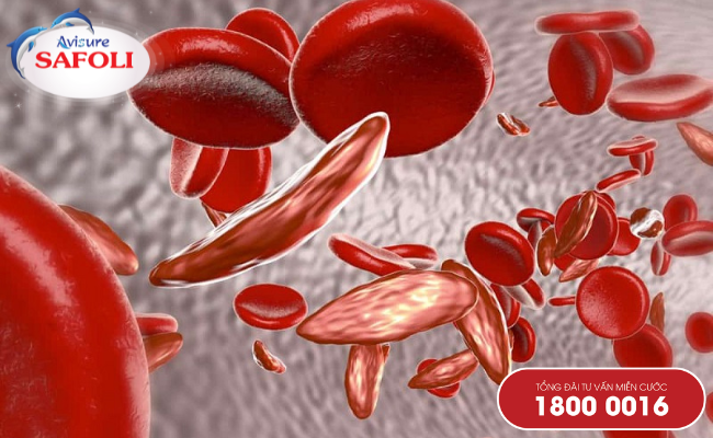Thiếu máu hồng cầu bệnh lý nguy hiểm ở trẻ em